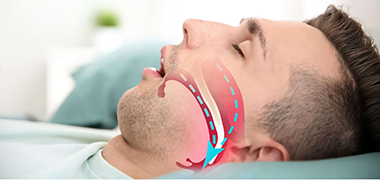 Obstructive Sleep Apnea	
